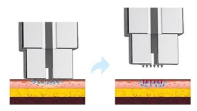 Schema: Die Mikronadeln des Chips öffnen feine Aqua-Kanäle in der Epidermis